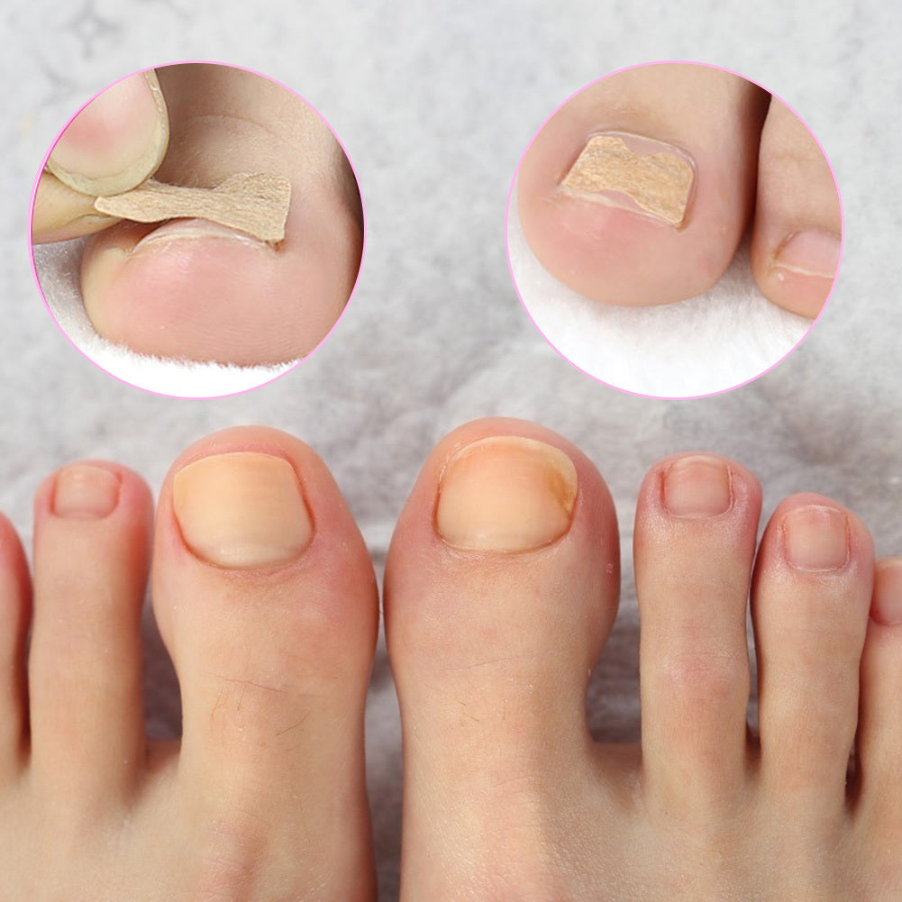 Ingrown Toenail Corrector Sticker MERLIÁ