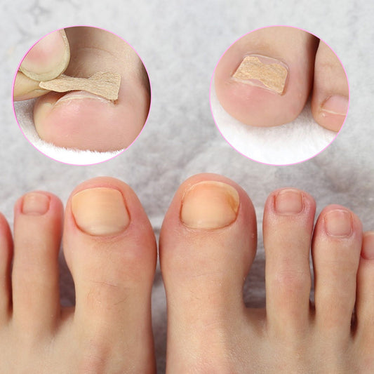 Ingrown Toenail Corrector Sticker MERLIÁ