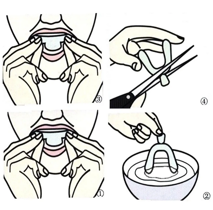 6 x Dental Whitening Tray MERLIÁ